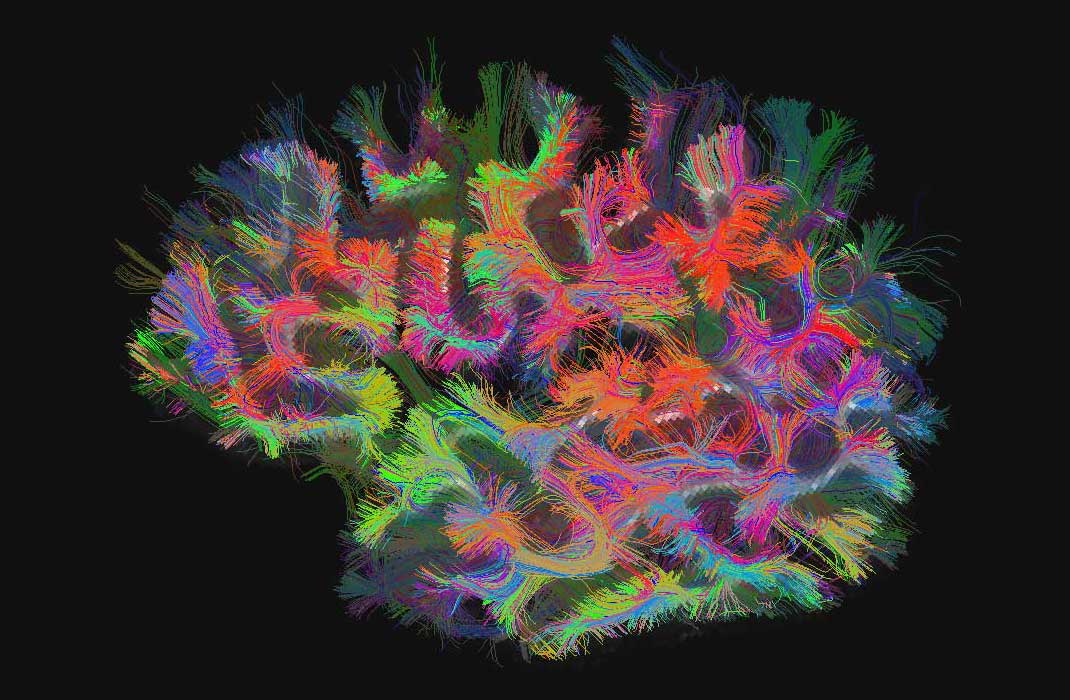 Brain Mapping for Parkinson's and OCD Treatment