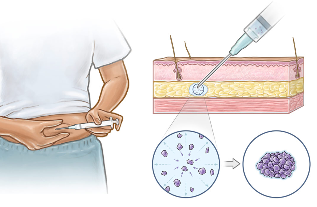 New Non-Surgical Contraceptive Implant is Delivered Through Tiny Needles