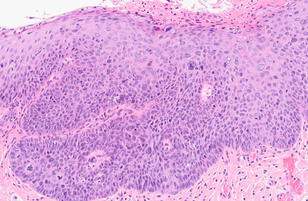 Pathology slide of HSIL