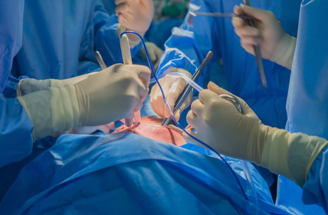 doctors performing a heart transplant