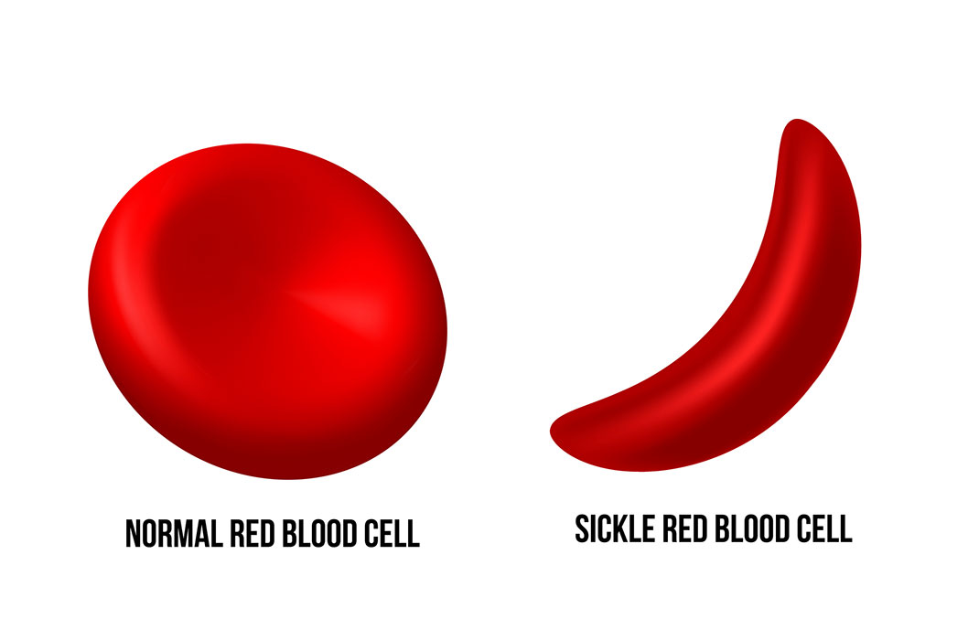 3D model of a normal red blood cell vs. a sickle red blood cell.