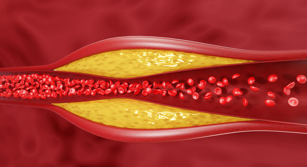 Cholesterol plaque buildup