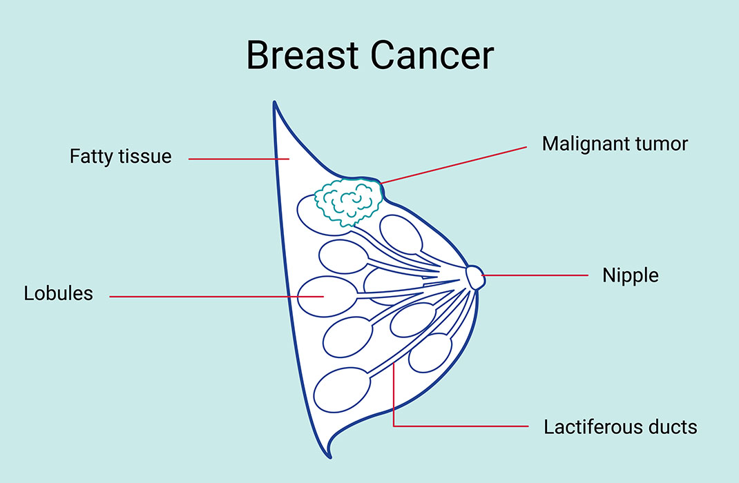 Breast Cancer Diagram 1070x700 