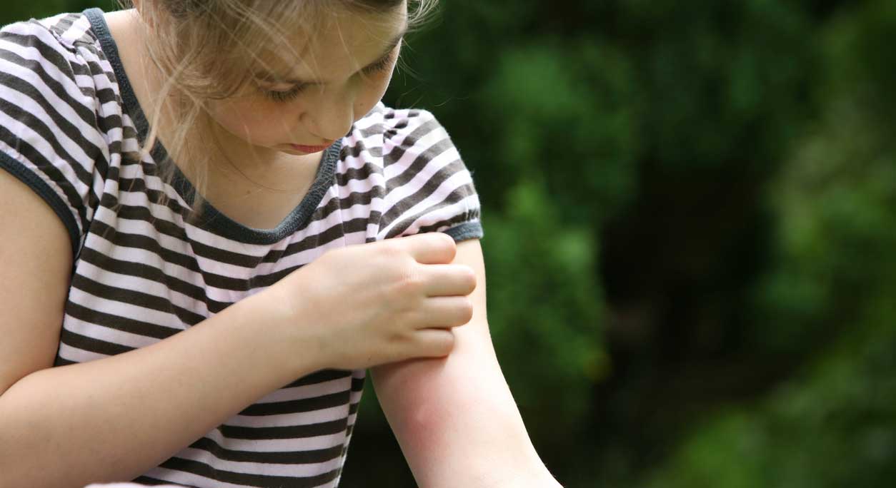 How to Care for Bug and Insect Bites