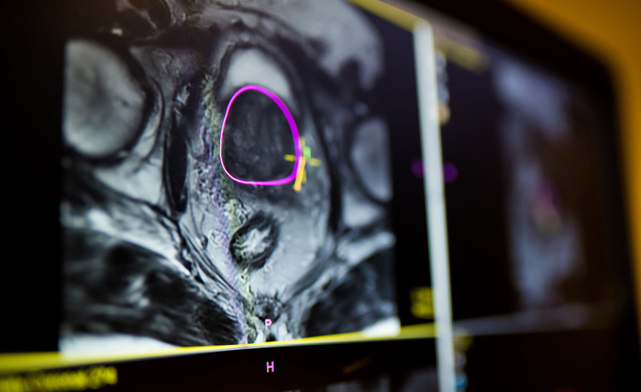 Prostate cancer shown on scan